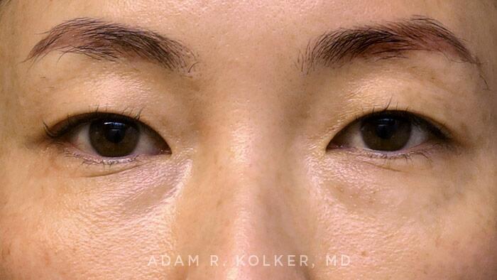 Blepharoplasty Before Image Patient 08 Front View
