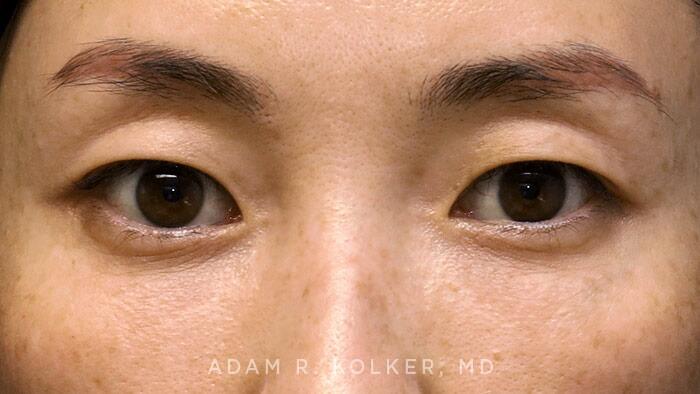 Blepharoplasty After Image Patient 08 Front View