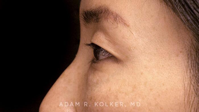 Blepharoplasty Before Image Patient 08 Side View