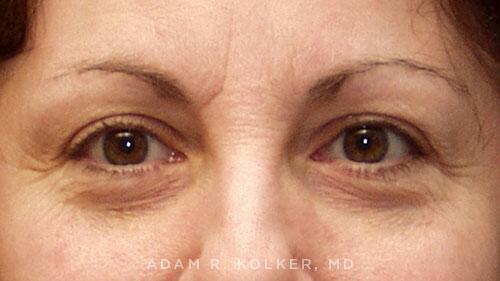 Blepharoplasty Before Image Patient 09 Front View