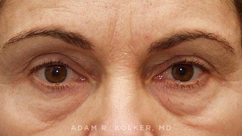 Blepharoplasty Before Image Patient 10 Front View