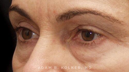 Blepharoplasty Before Image Patient 10 Oblique View