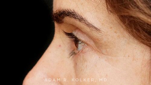 Blepharoplasty After Image Patient 10 Side View