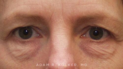 Blepharoplasty Before Image Patient 11 Front View