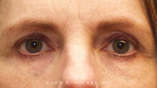 Blepharoplasty After Image Patient 11 Front View