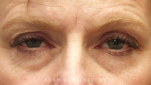 Blepharoplasty Before Image Patient 12 Front View