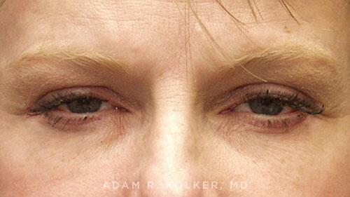 Blepharoplasty After Image Patient 12 Front View