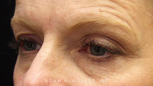 Blepharoplasty Before Image Patient 12 Oblique View