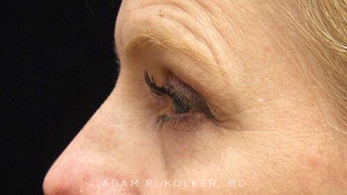 Blepharoplasty Before Image Patient 12 Side View