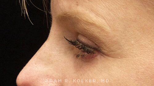 Blepharoplasty After Image Patient 12 Side View