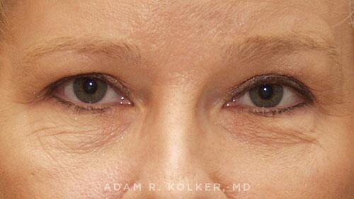 Blepharoplasty Before Image Patient 13 Front View