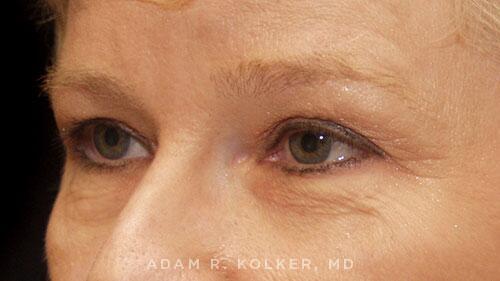 Blepharoplasty Before Image Patient 13 Oblique View