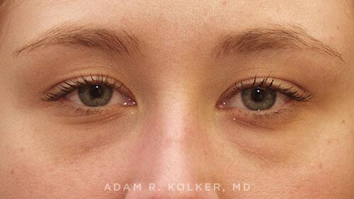 Blepharoplasty Before Image Patient 14 Front View