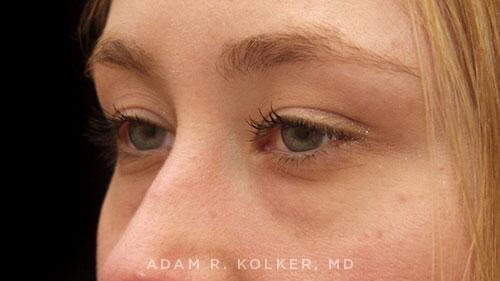 Blepharoplasty Before Image Patient 14 Oblique View