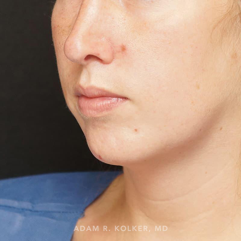 Chin Implant Before Image Patient 03 Oblique View