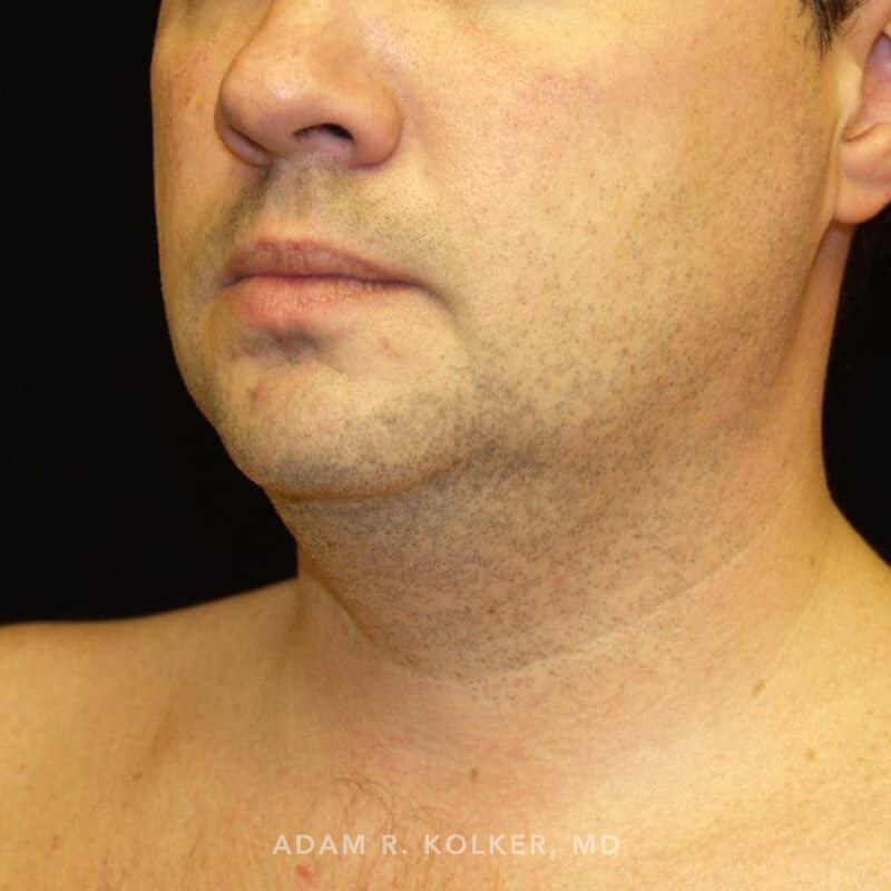 Chin Implant Before Image Patient 05 Oblique View