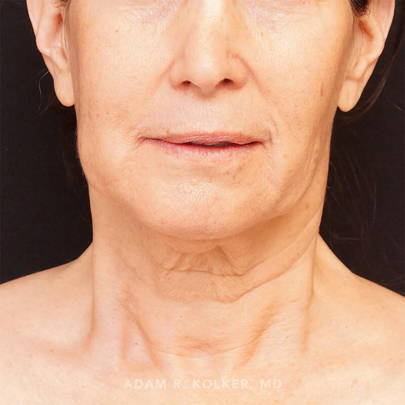 Facelift Before Image Patient 01 Front View