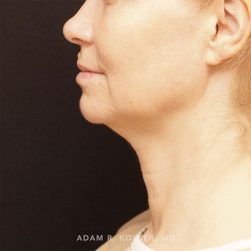 Facelift Before Image Patient 02 Side View