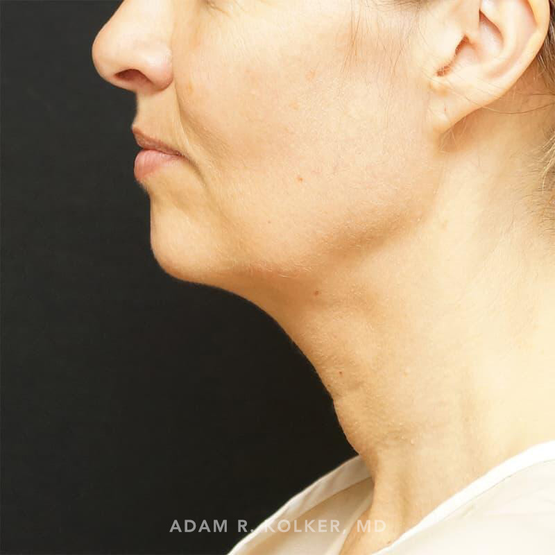 Facelift Before Image Patient 03 Side View