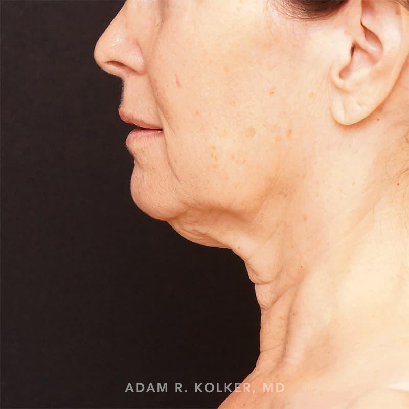 Neck Lift Before Image Patient 01 Side View
