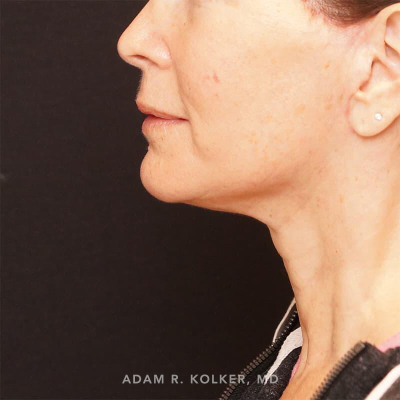 Neck Lift After Image Patient 01 Side View
