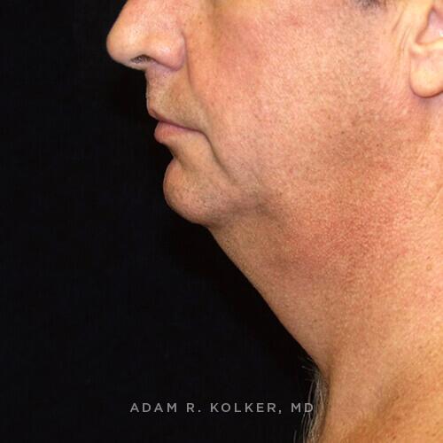 Neck Lift Before Image Patient 03 Side View