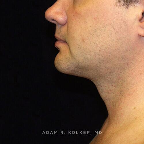 Neck Lift After Image Patient 04 Side View