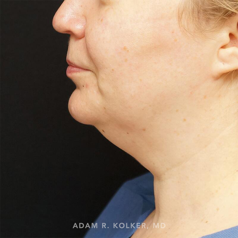 Neck Liposuction Before Image Patient 01 Side View