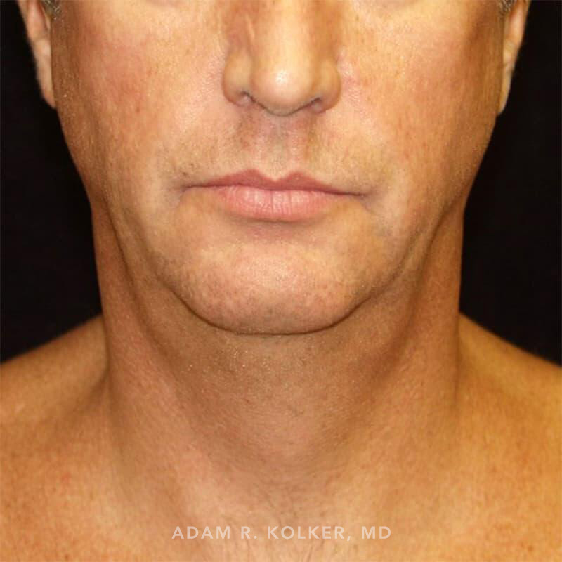 Neck Liposuction Before Image Patient 02 Front View
