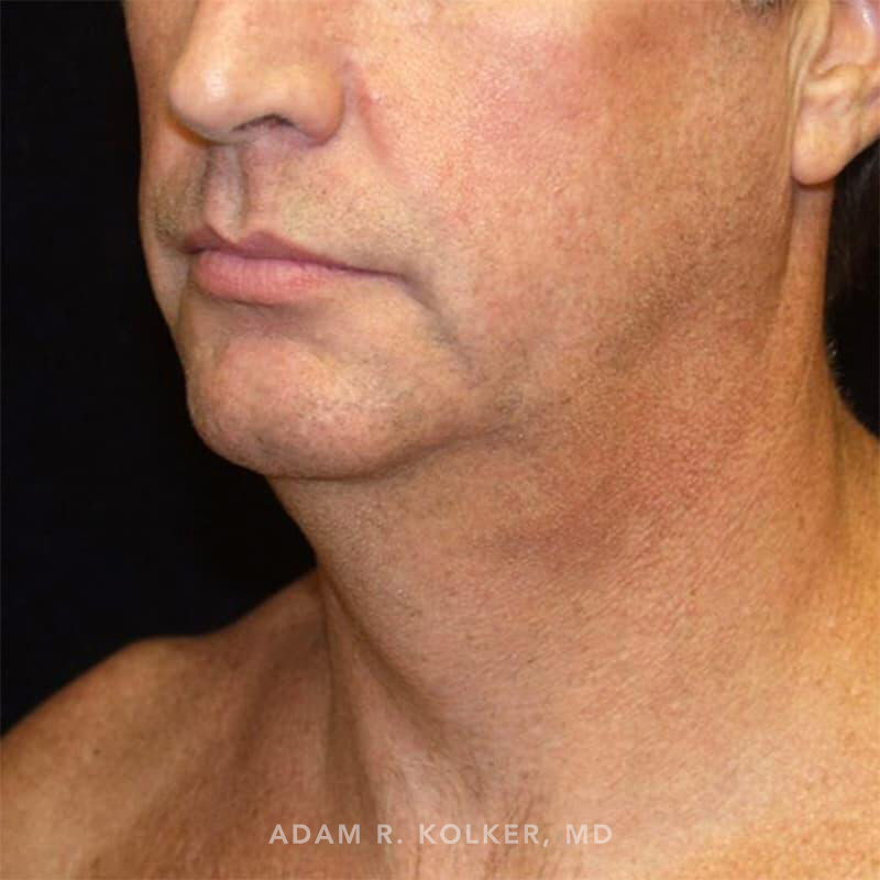 Neck Liposuction Before Image Patient 02 Oblique View