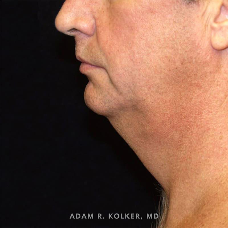 Neck Liposuction Before Image Patient 02 Side View