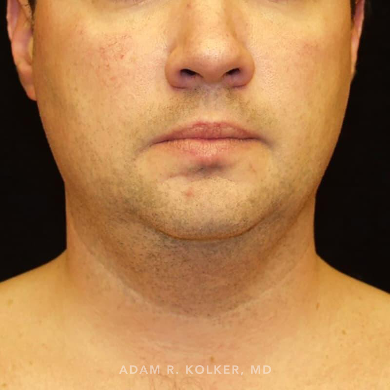 Neck Liposuction Before Image Patient 03 Front View