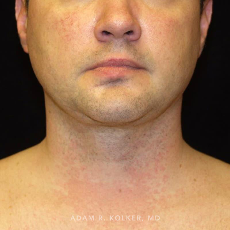 Neck Liposuction After Image Patient 03 Front View