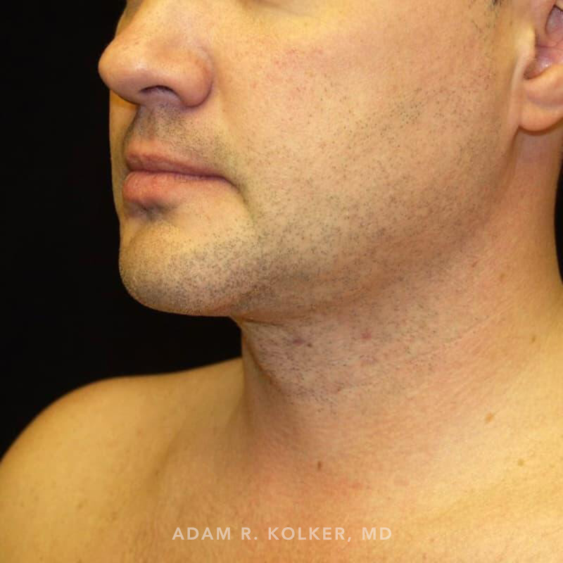 Neck Liposuction After Image Patient 03 Oblique View