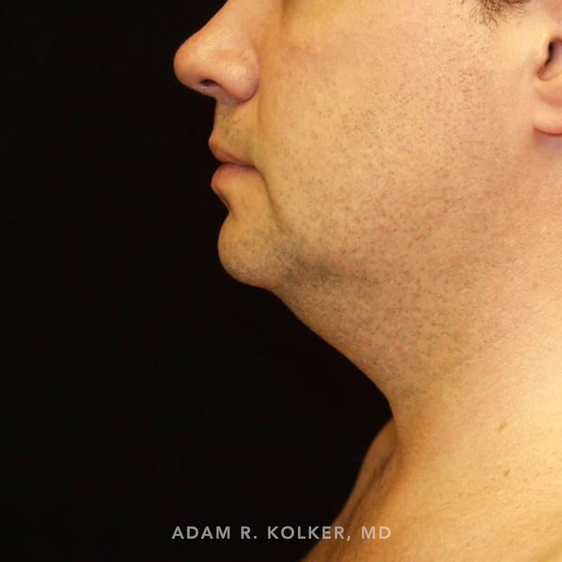 Neck Liposuction Before Image Patient 03 Side View