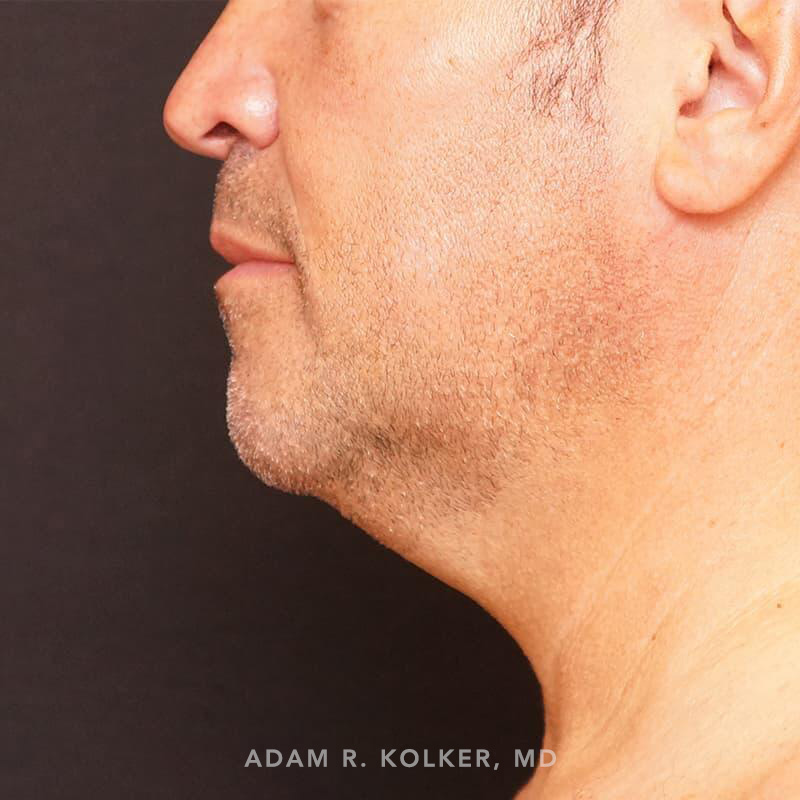 Neck Liposuction Before Image Patient 04 Side View