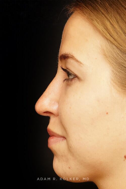 Rhinoplasty After Image Patient 01 Side View