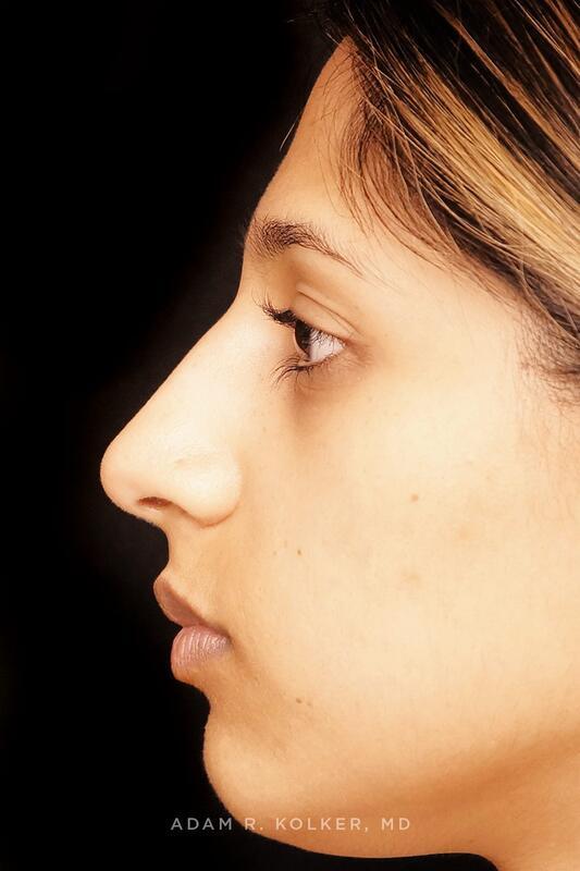 Rhinoplasty Before Image Patient 02 Side View