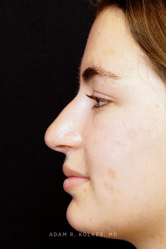Rhinoplasty Before Image Patient 03 Side View
