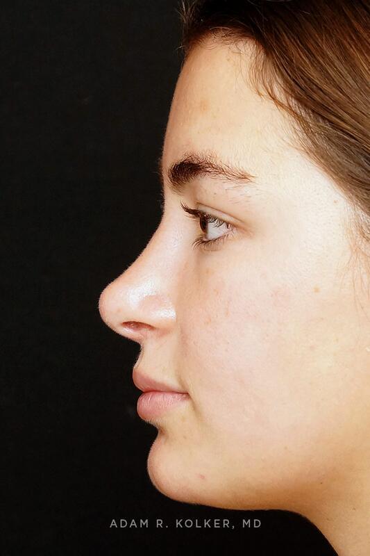 Rhinoplasty After Image Patient 03 Side View