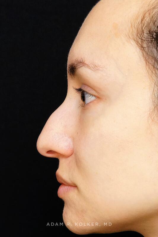 Rhinoplasty Before Image Patient 04 Side View