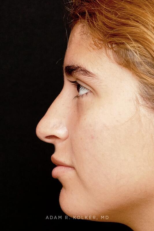 Rhinoplasty Before Image Patient 05 Side View