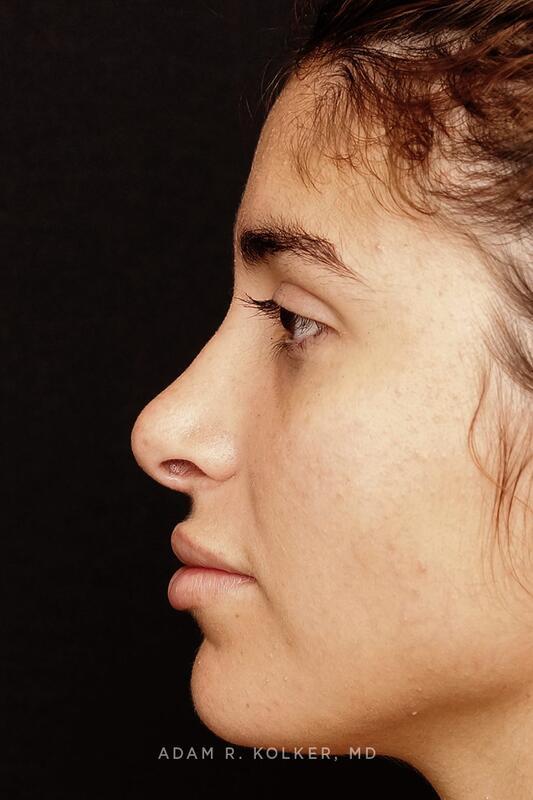 Rhinoplasty After Image Patient 05 Side View