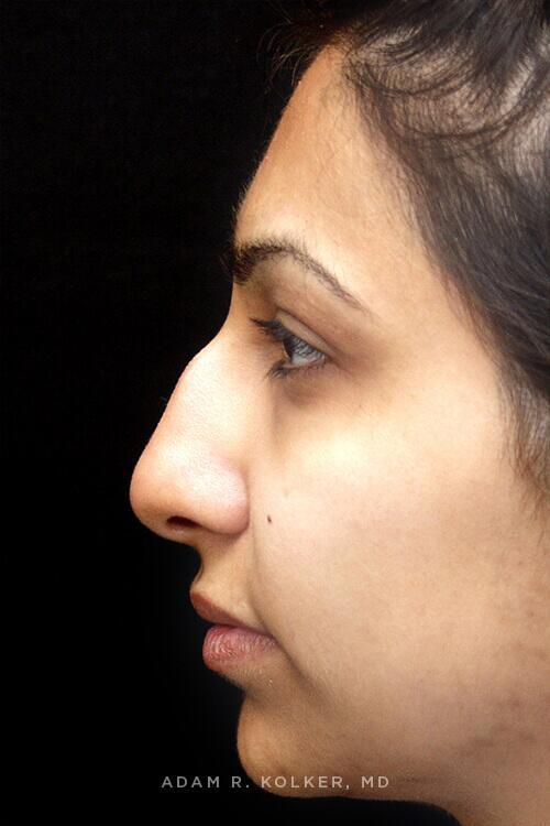 Rhinoplasty Before Image Patient 06 Side View