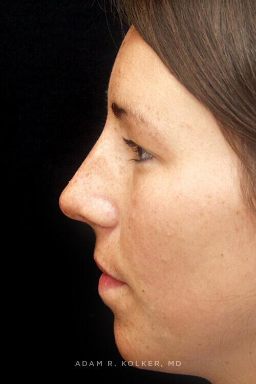 Rhinoplasty Before Image Patient 07 Side View