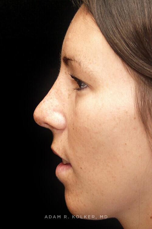 Rhinoplasty After Image Patient 07 Side View