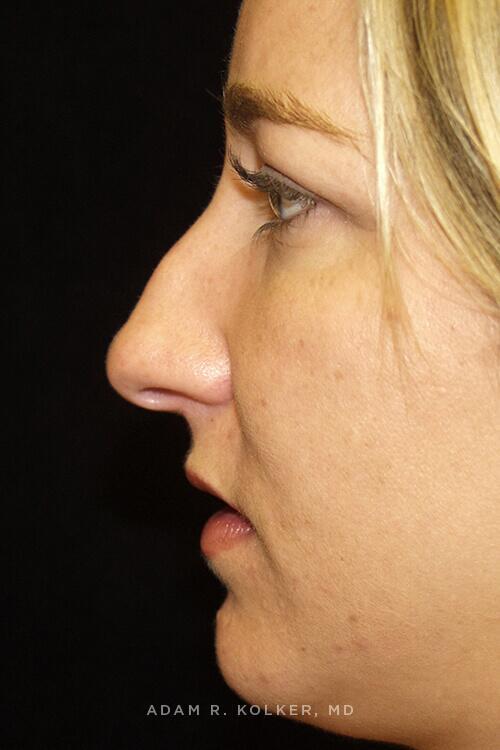 Rhinoplasty Before Image Patient 08 Side View