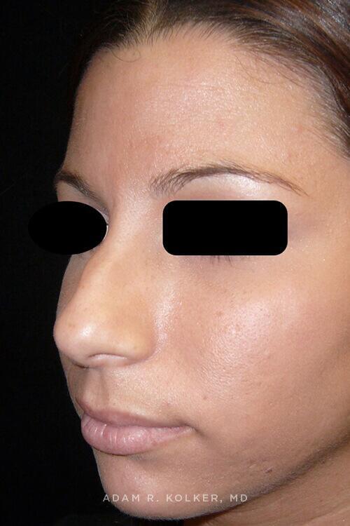 Rhinoplasty Before Image Patient 11 Oblique View