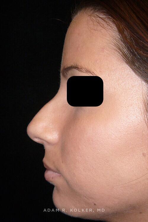 Rhinoplasty Before Image Patient 11 Side View