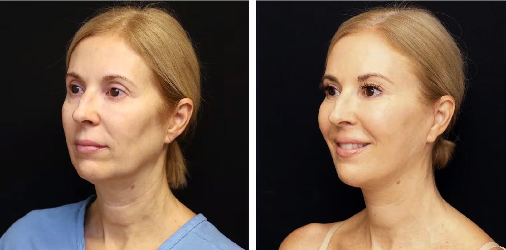 Kristen's facelift facial rejuvenation Before and After Photos